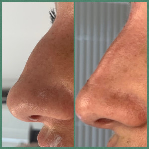 Non Surgical Rhinoplasty