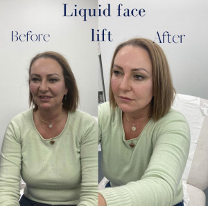 Liquid Face Lift