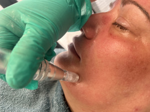 Luxury Microneedling Face & Neck